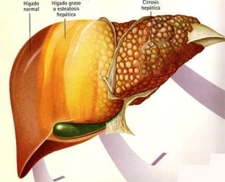 Esteatosis+Hepatica+Leve La esteatosis hepática no es tan mala y puede tener solución - La ...