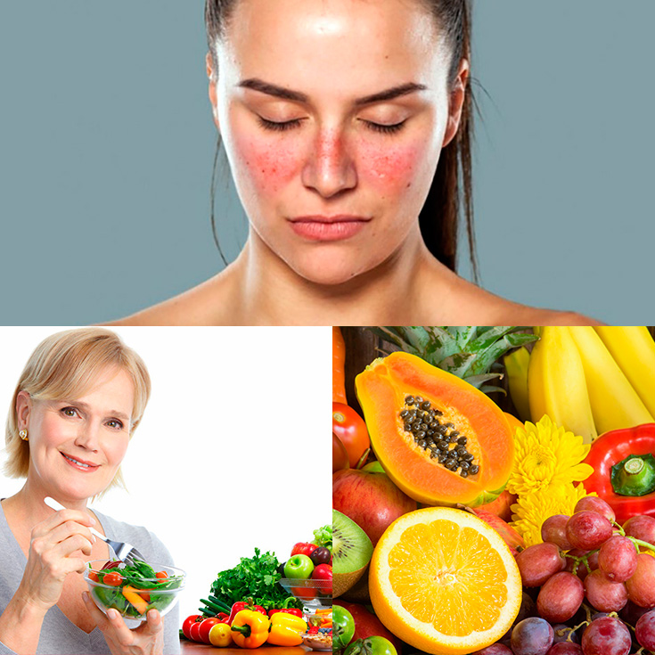 Resultado de imagen para Lupus y Dieta.