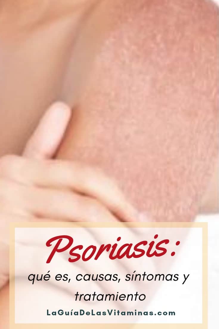 Psoriasis Qu Es Causas S Ntomas Y Tratamiento La Gu A De Las