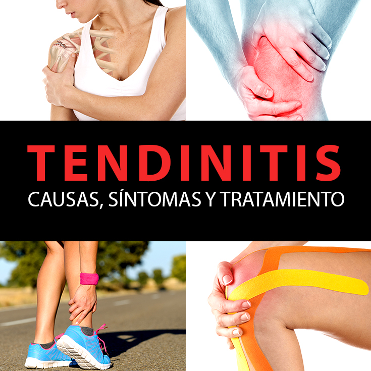 Tendinitis causas síntomas y tratamiento La Guía de las Vitaminas