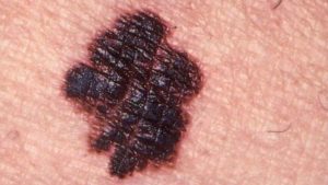 melanoma