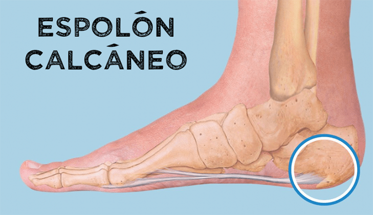 cómo eliminar los espolones de talón o calcáneo la guía de las vitaminas