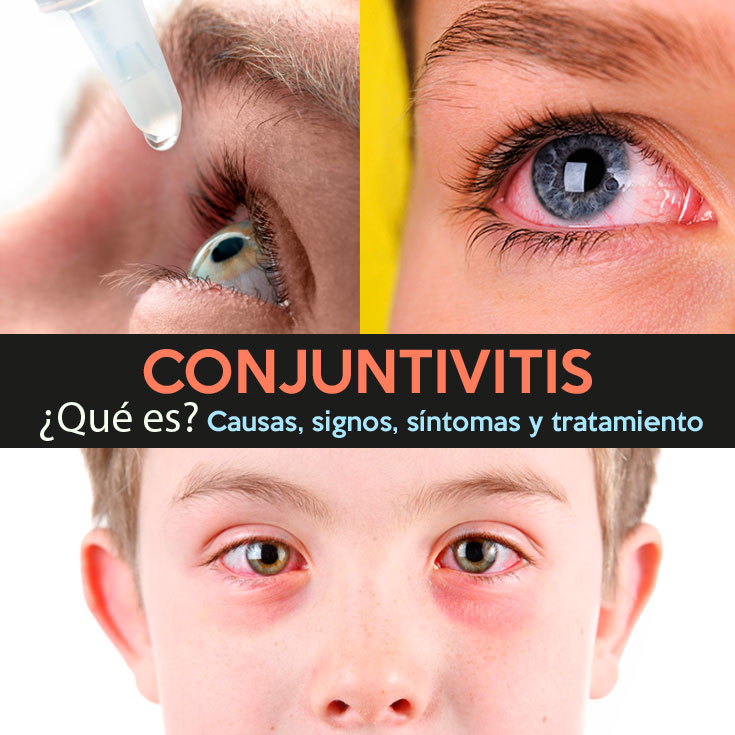 Conjuntivitis Que Es Causas Signos Sintomas Y Tratamiento La Guía De