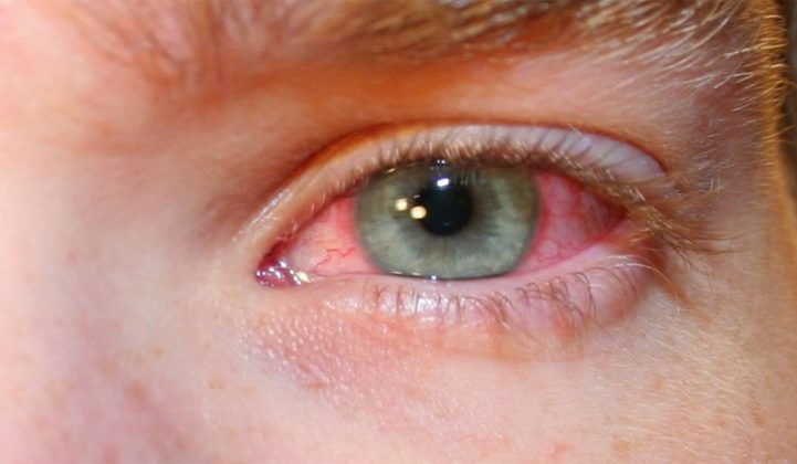 Conjuntivitis Infecciosas Bacterial Y Viral Síntomas Causas Y