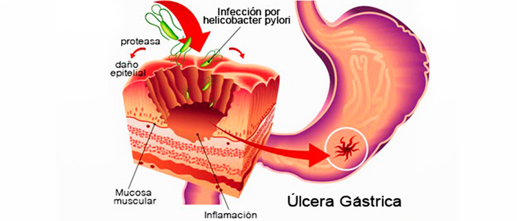 úlcera gástrica y dolor en la boca del estómago