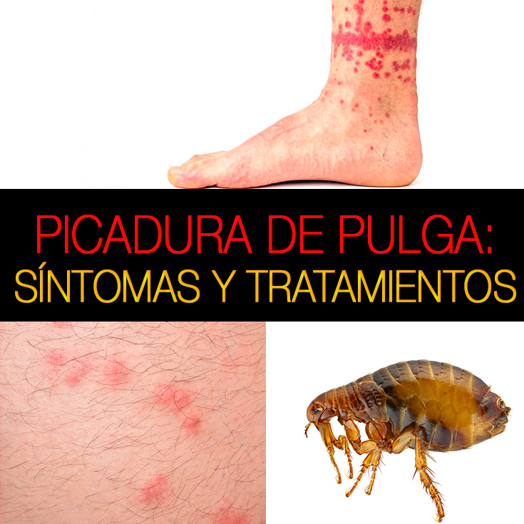 Picadura de pulga en humanos: cómo identificar, síntomas, riesgos y ...