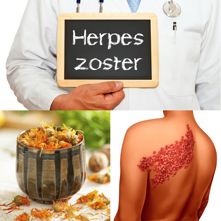 Culebrilla (herpes zóster): causas, síntomas y tratamiento
