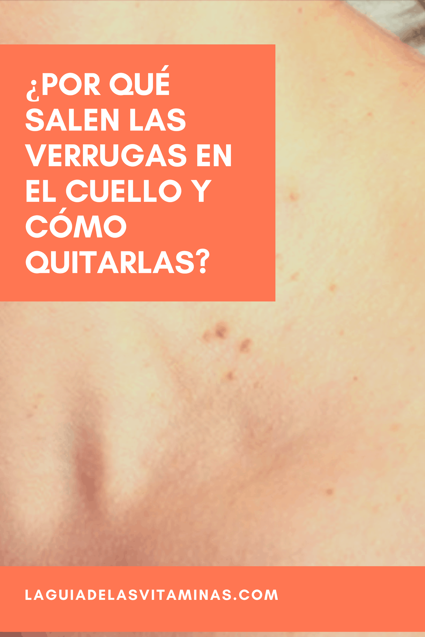 Por Qu Salen Las Verrugas En El Cuello Y C Mo Quitarlas La Gu A