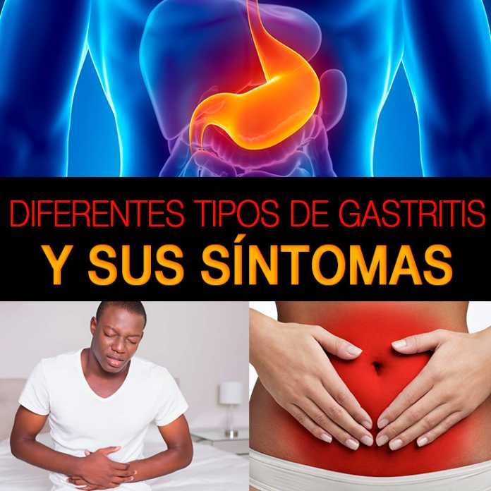 Diferentestiposdegastritisysussíntomas1 La Guía de las Vitaminas