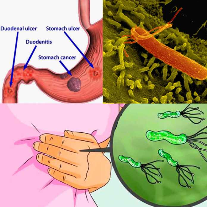Gastritis-por-helicobacter-pylori | La Guía de las Vitaminas