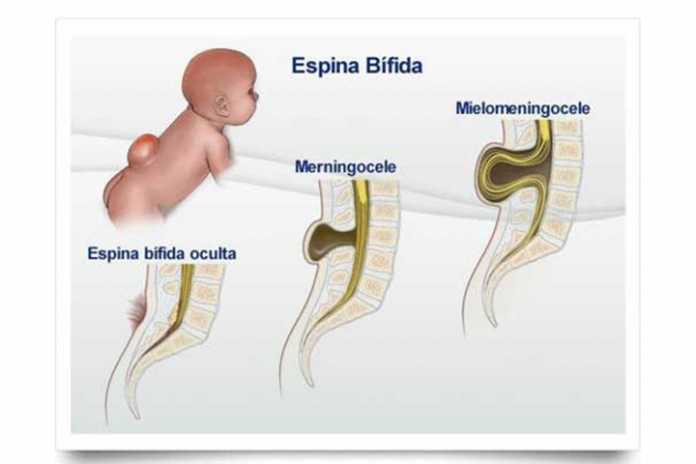 Mielomeningocele Causas Síntomas Diagnóstico Y Tratamiento La Guía De Las Vitaminas 4165