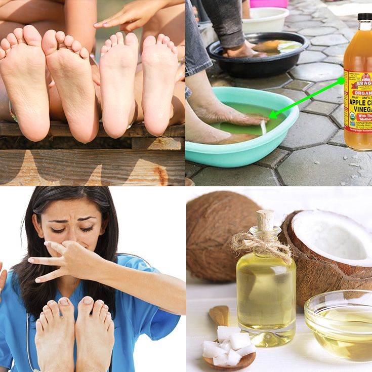 5 remedios caseros para el sudor de pies