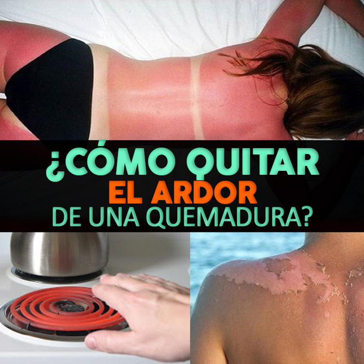 Cómo Quitar El Ardor De Una Quemadura + 8 Remedios - La Guía de las ... Cómo Quitar El Ardor De Una Quemadura + 8 Remedios - La Guía de las ...