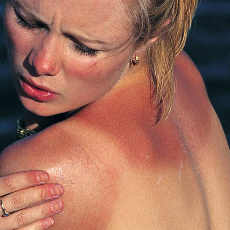Cómo aclarar la piel quemada por el sol – cómo quitar lo quemado por el sol