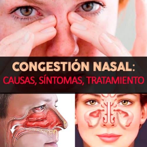 Congestión Nasal: Causas, Síntomas Acompañantes Y Tratamiento - La Guía ...