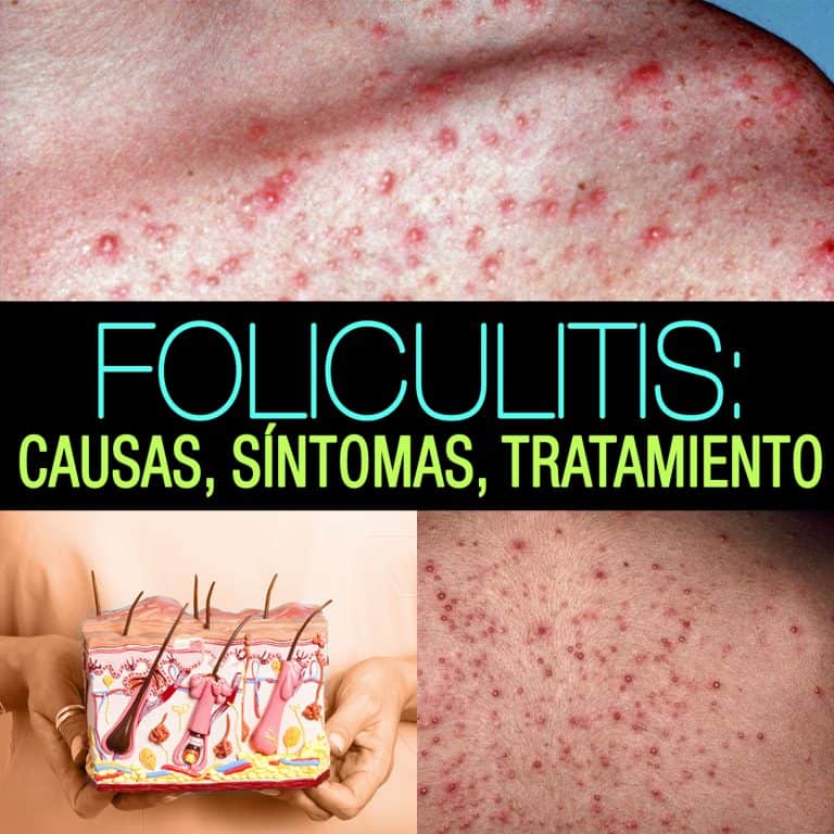 Foliculitis Causas Síntomas Tratamiento Y Complicaciones La Guía