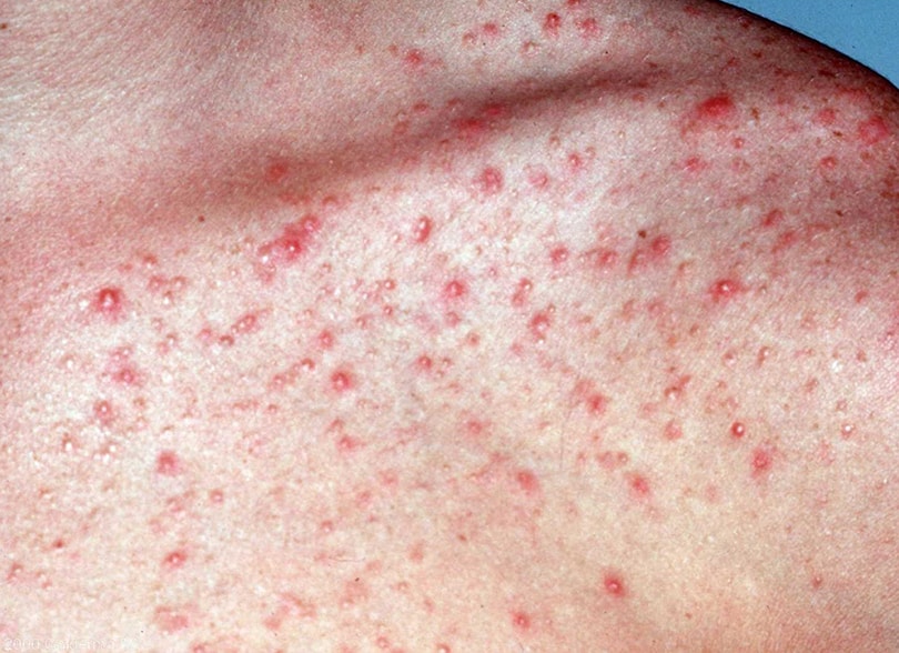 Foliculitis causas síntomas tratamiento y complicaciones La Guía de las Vitaminas