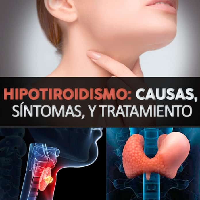 Hipotiroidismo Qué Es Causas Síntomas Y Tratamiento La Guía De