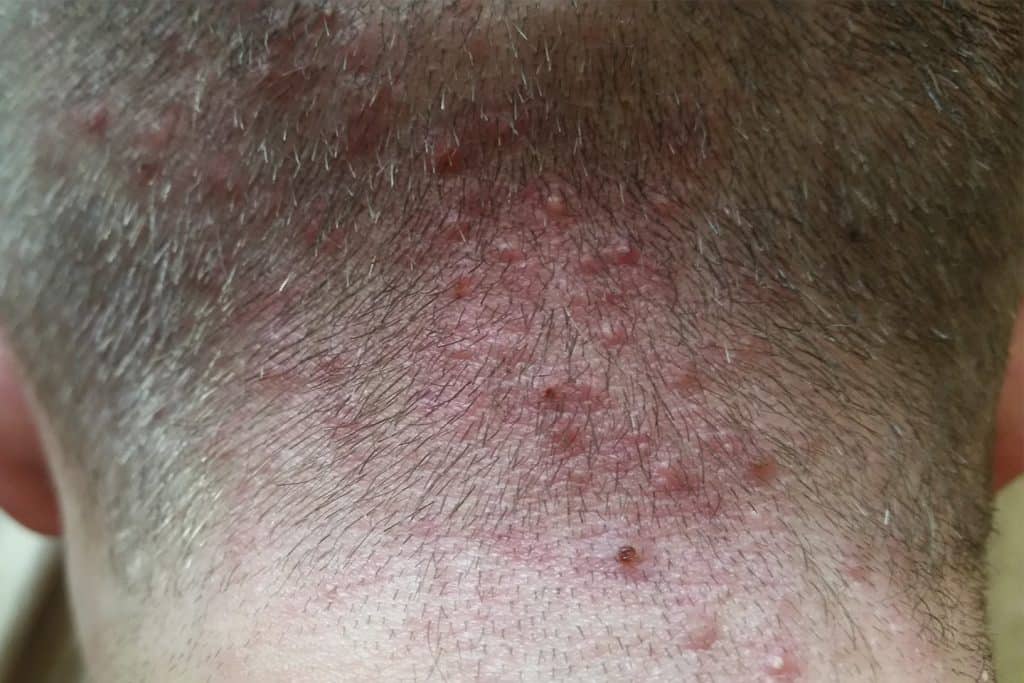 Foliculitis Causas Síntomas Tratamiento Y Complicaciones La Guía