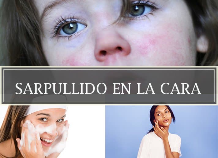 Sarpullido en la cara posibles causas y tratamiento La