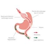 Bypass gastrico