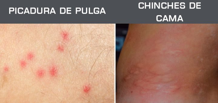 Picadura De Una Pulga PICADURAS DE PULGAS Todo Lo Que Necesitas Picadura De Una Pulga PICADURAS DE PULGAS Todo Lo Que Necesitas