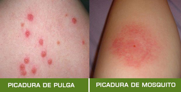 Alergia A Pulga Em Humanos Picada De Carrapato Em Humanos Sintomas Alergia A Pulga Em Humanos Picada De Carrapato Em Humanos Sintomas